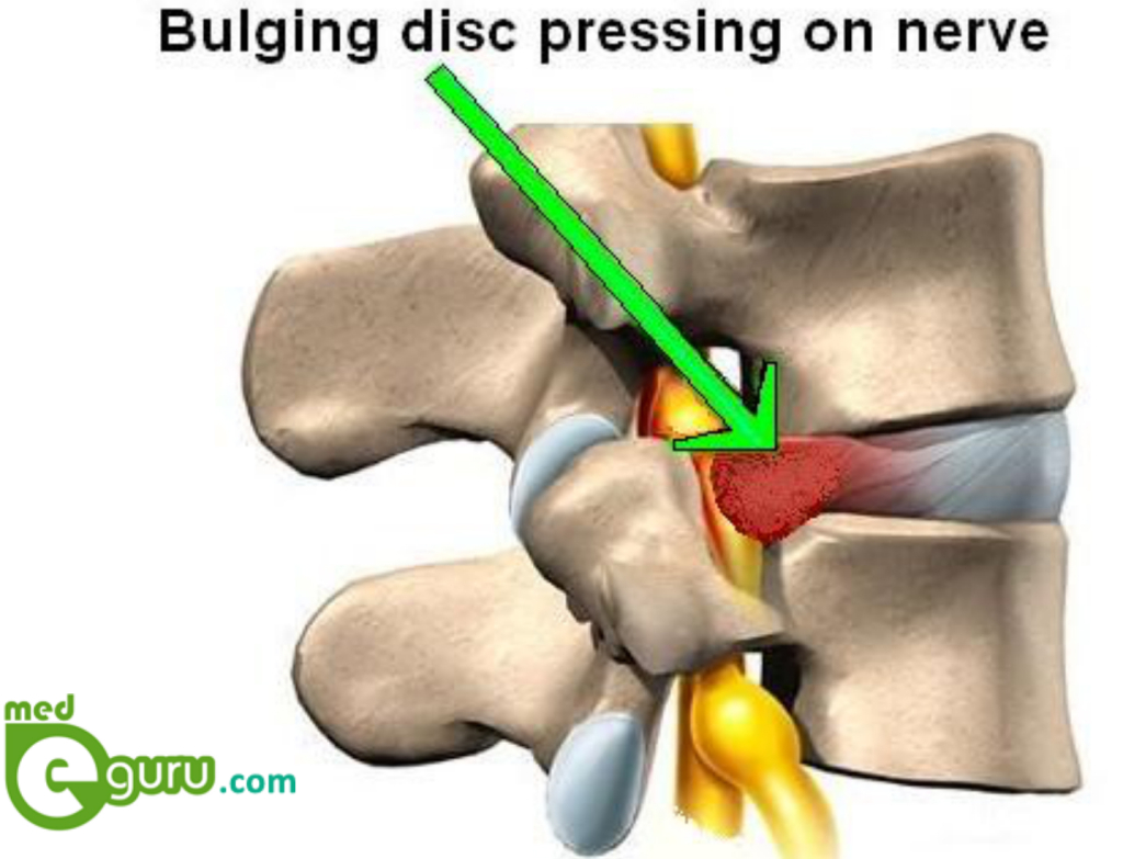 how-bulging-disc-is-caused-treatments-for-bulging-discsmed-e-guru