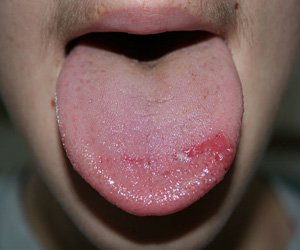 burning-mouth-syndrome-medeguru