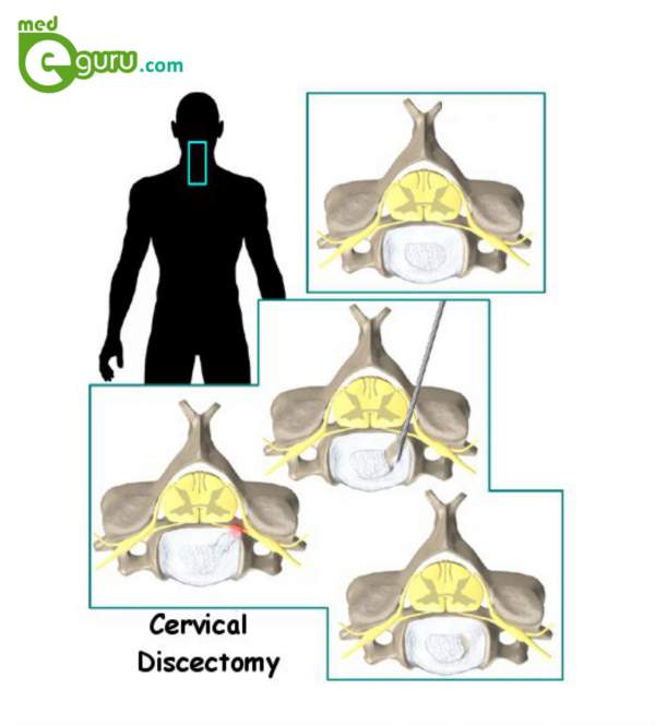 cervical discectomy and Fusion
