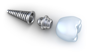 dental-implants-technology-medeguru
