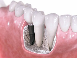 dental-tooth-implants