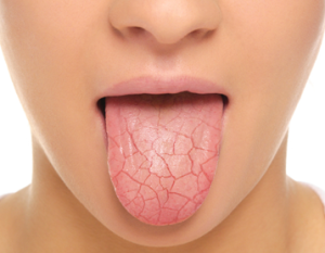 dry-mouth-syndrom-medeguru