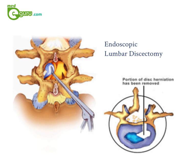 Endoscopic Lumbar Discectomy