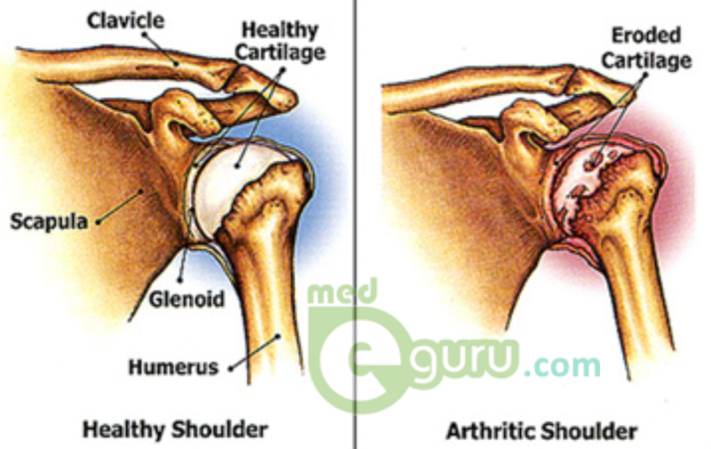 Shoulder Arthritis