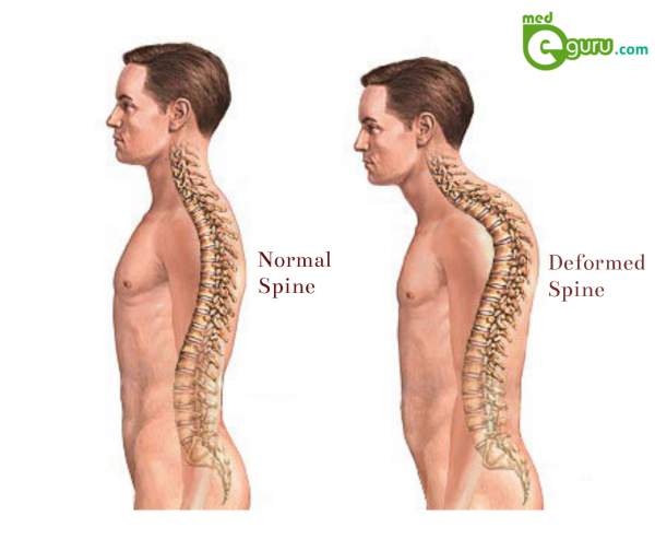 What is Spinal Deformity