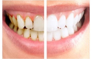 teeth-disorder-medeguru