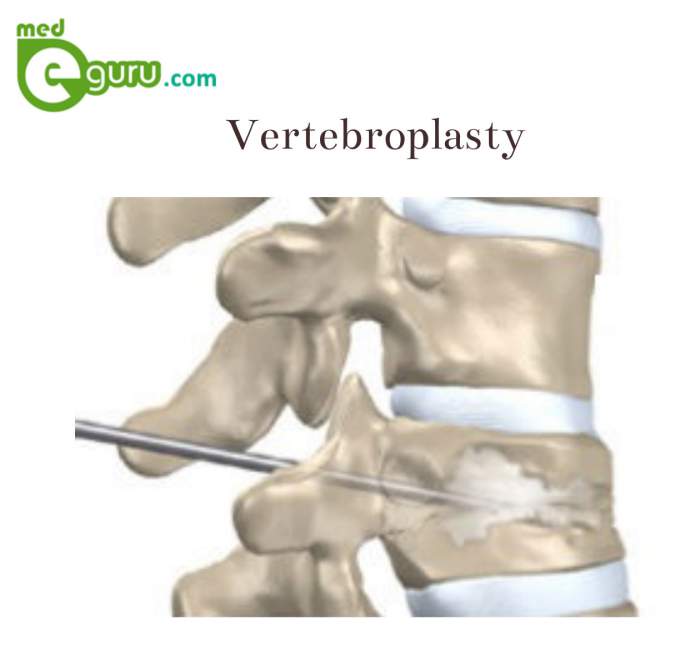What is vertebroplasty