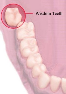 wisdom-teeth-medeguru