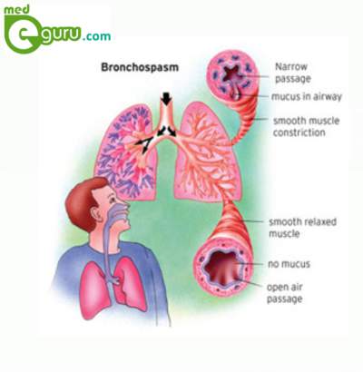 Bronchospasm diagram
