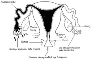 HYSTEROSALPINGOGRAM