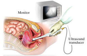 TransvaginalUltrasound