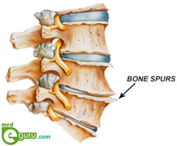 what is a Bone Spur | Bone Spurs TreatmentMed E Guru