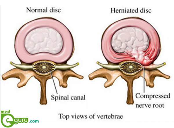 Herniated disc Diagram