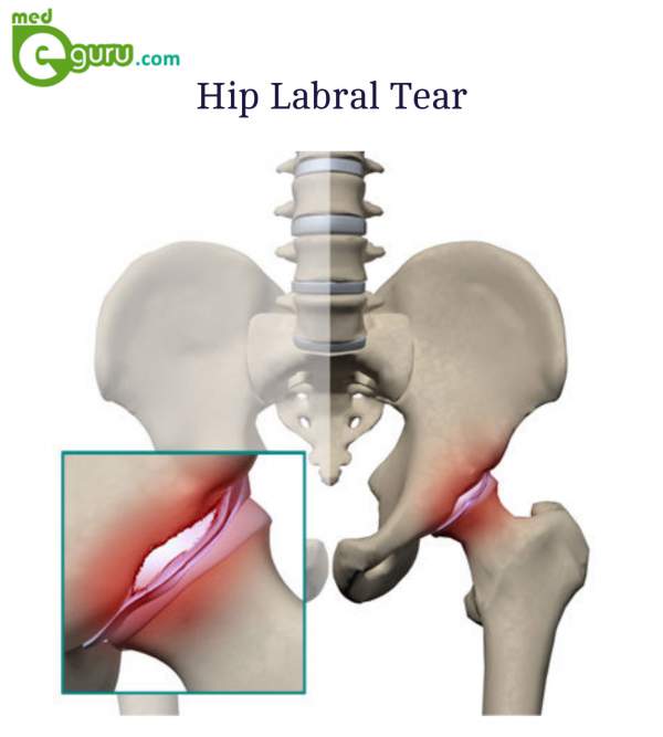 What is Hip Labral Tear