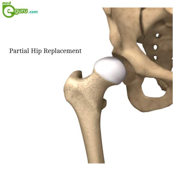 Albums 100+ Images what does a partial hip replacement look like Updated