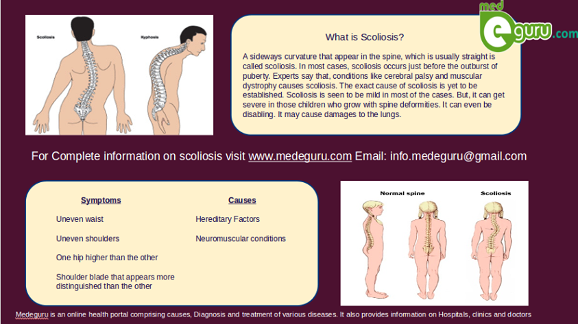 What Causes Scoliosis? Symptoms, Treatment, and Care at Neuro Spinal  Hospital