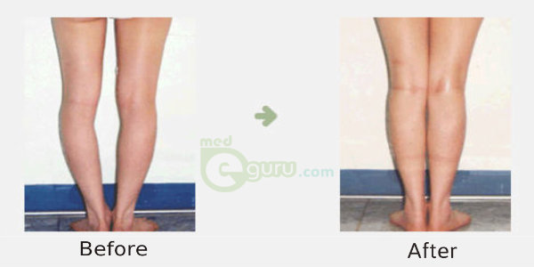 Correction of Bow legs  How to fix Bowed LegMed E Guru